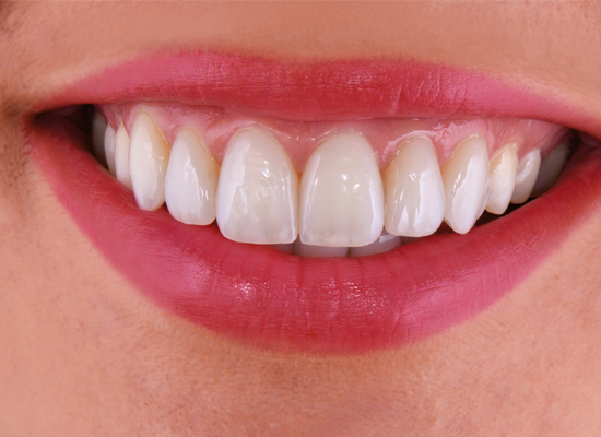 Crown1 Crown and Bridge