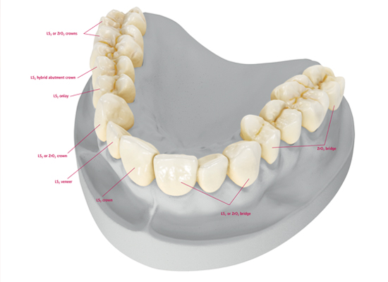 Crown2 Crown and Bridge
