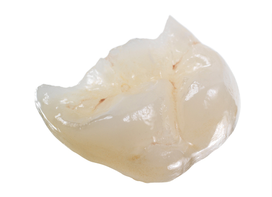 Crown4 Crown and Bridge