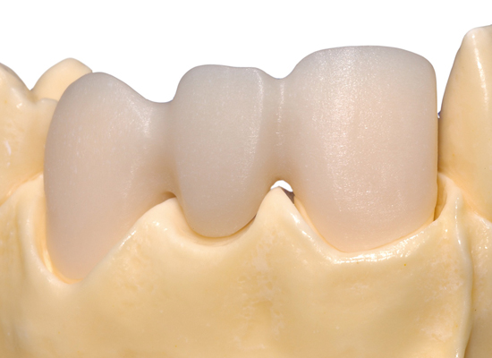 Crown5 Crown and Bridge