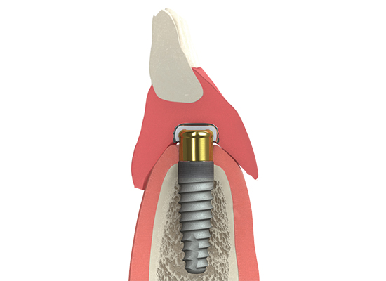 ImplantsB