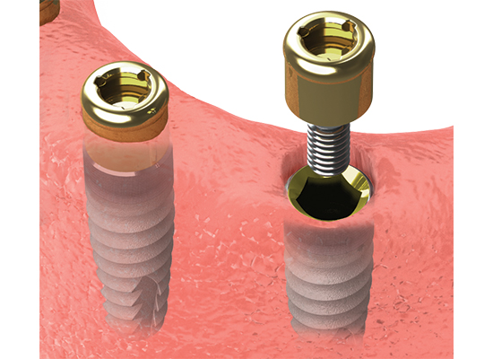 ImplantsD