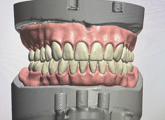Digital Dentures Digital Dentures